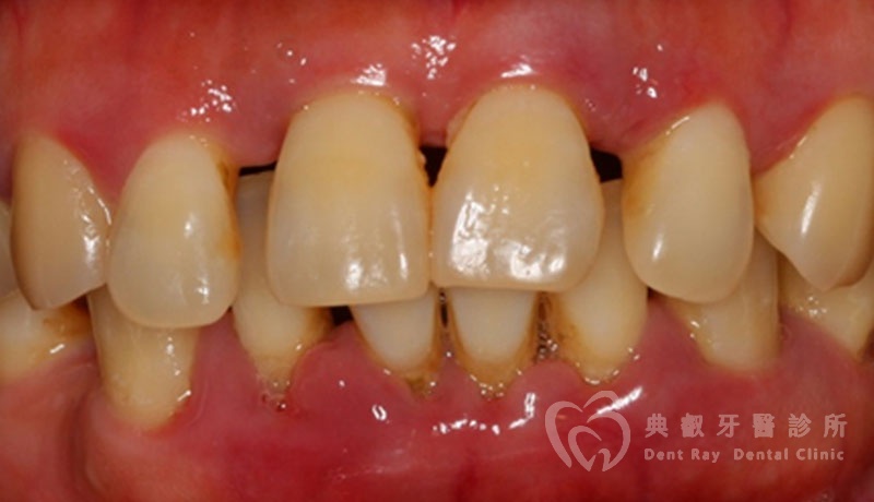 非手術性牙周病治療