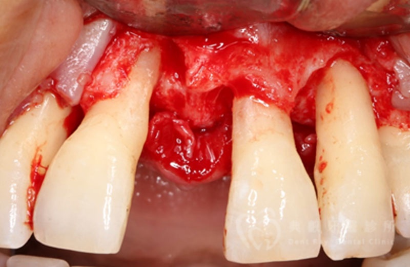 牙周手術案例四