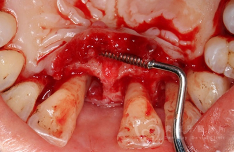 牙周手術案例四