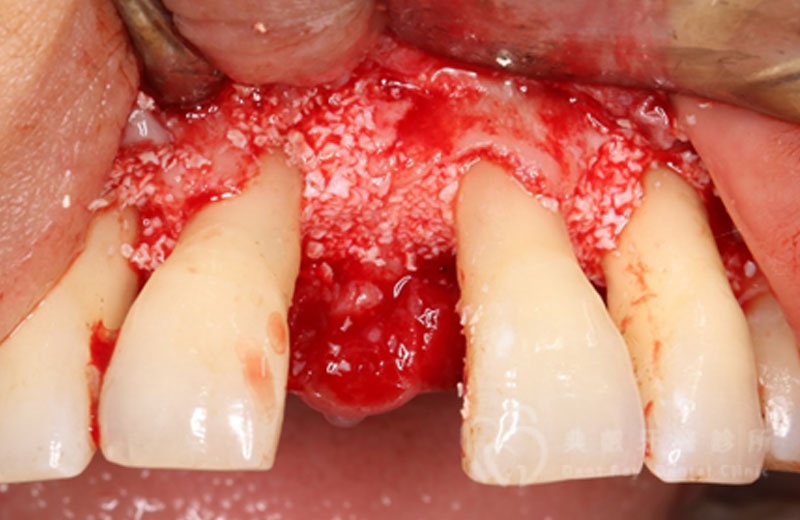 牙周手術案例四