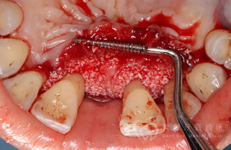 牙周手術案例四