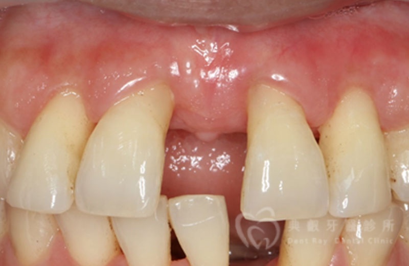 牙周手術案例四