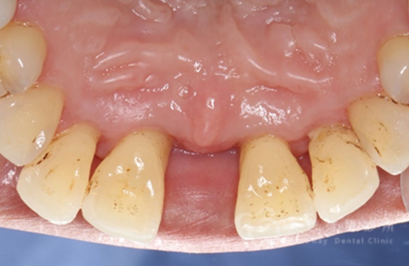 牙周手術案例四