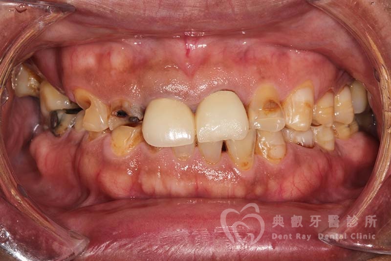 假牙案例十二