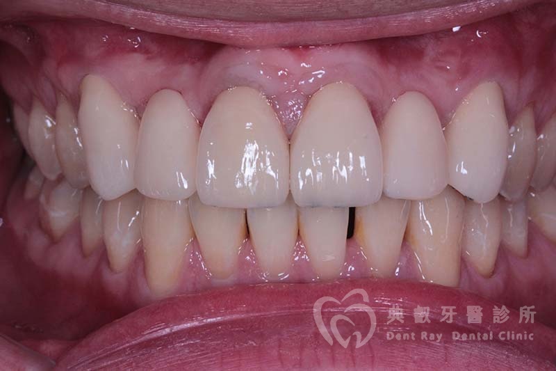 固定假牙案例一