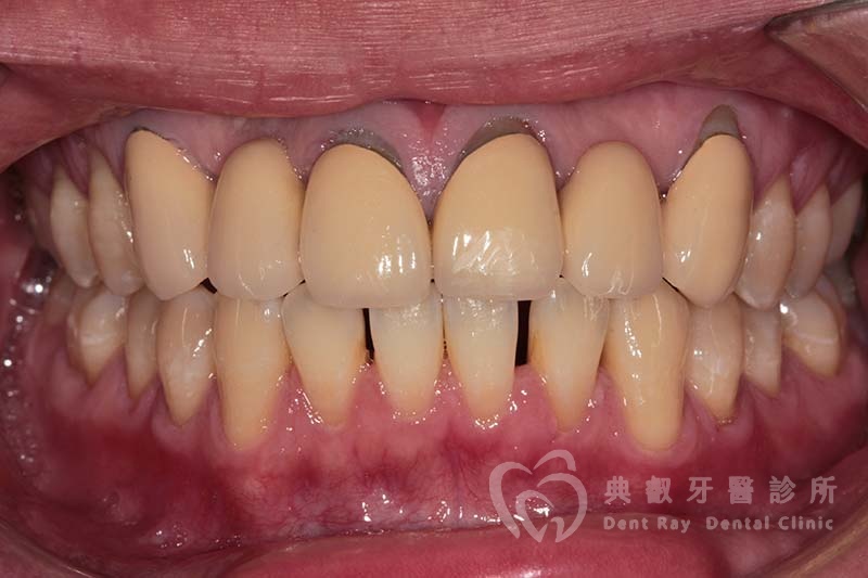 固定假牙案例一