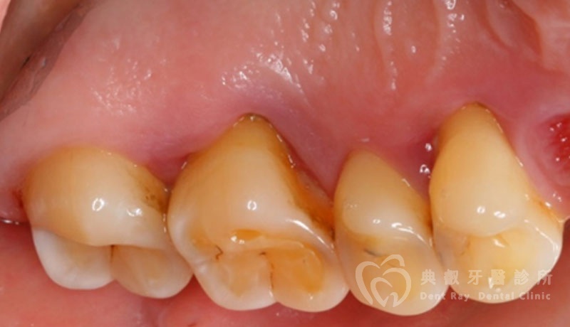 非手術性牙周病治療