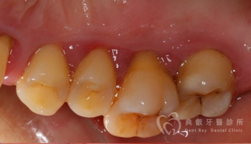 非手術性牙周病治療