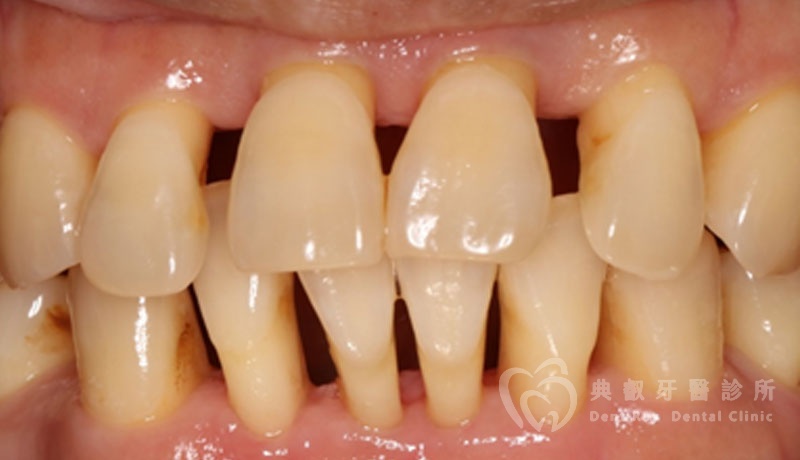 非手術性牙周病治療