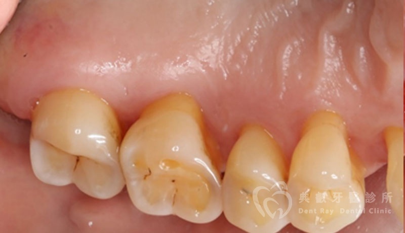 非手術性牙周病治療