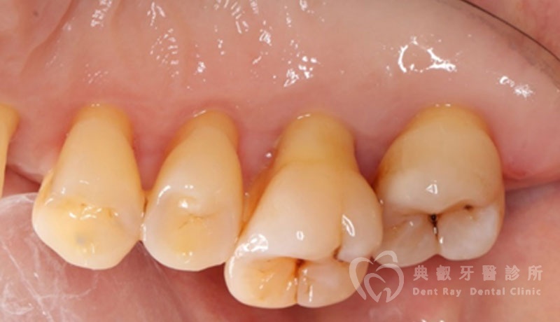 非手術性牙周病治療