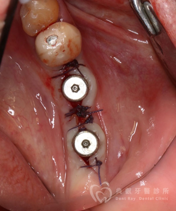 植牙案例三