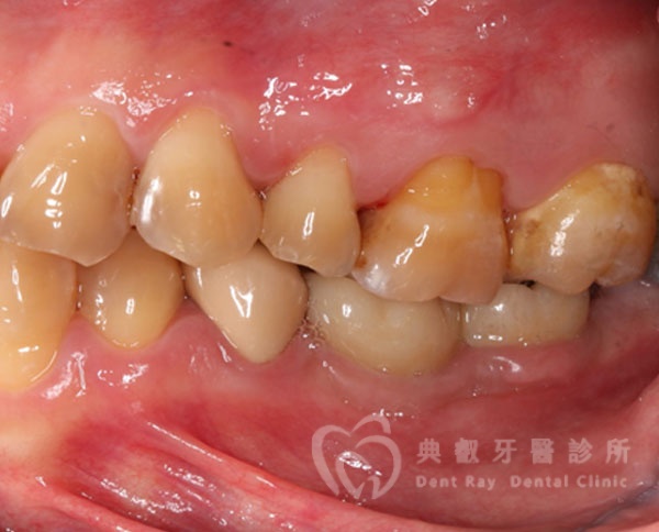 植牙案例三