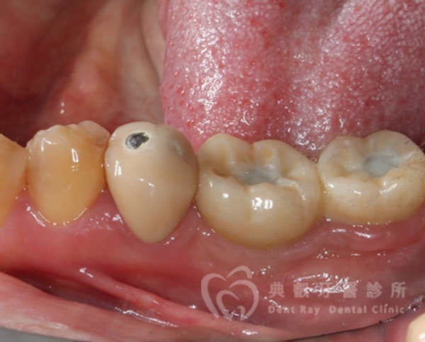 植牙案例三