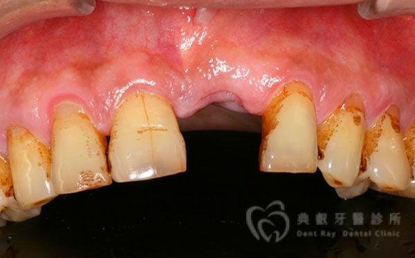 植牙案例四