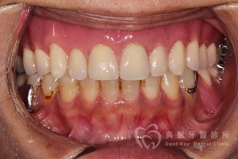 假牙案例五