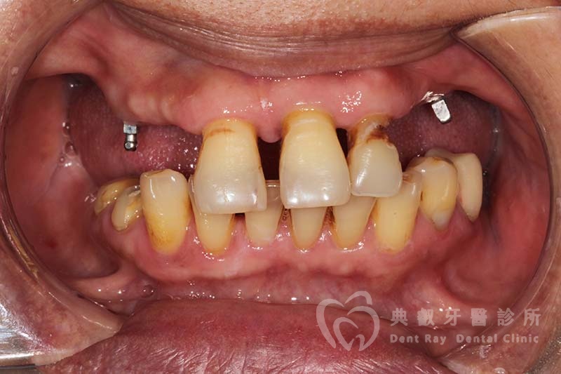 假牙案例六