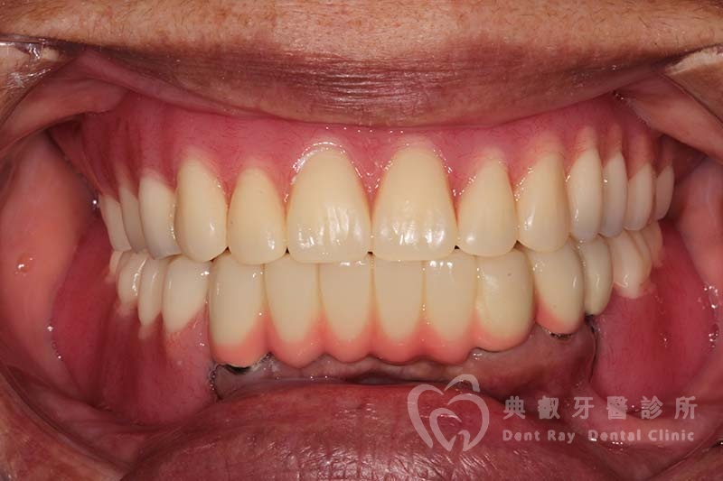 假牙案例七