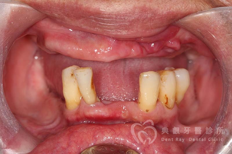 假牙案例七