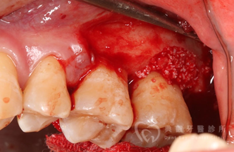 牙周手術案例一