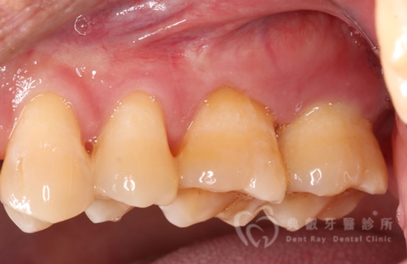 牙周手術案例一