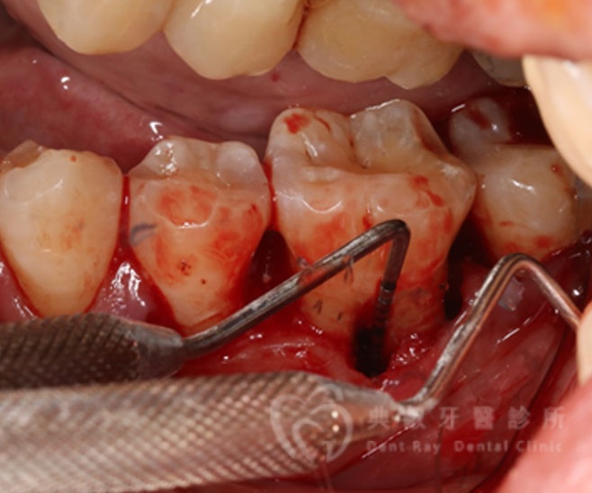 牙周手術案例二