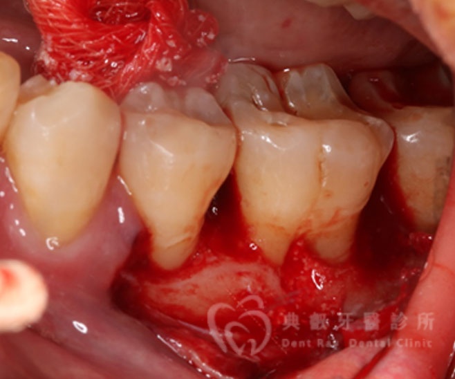 牙周手術案例二