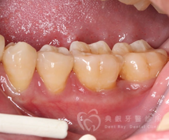 牙周手術案例二