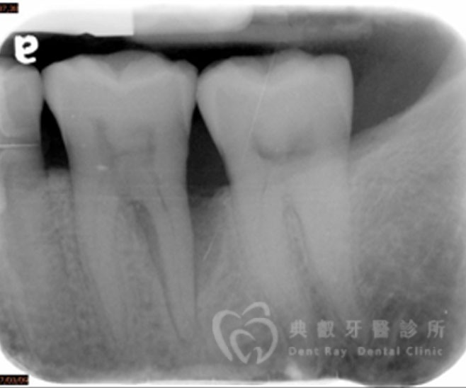 牙周手術案例二