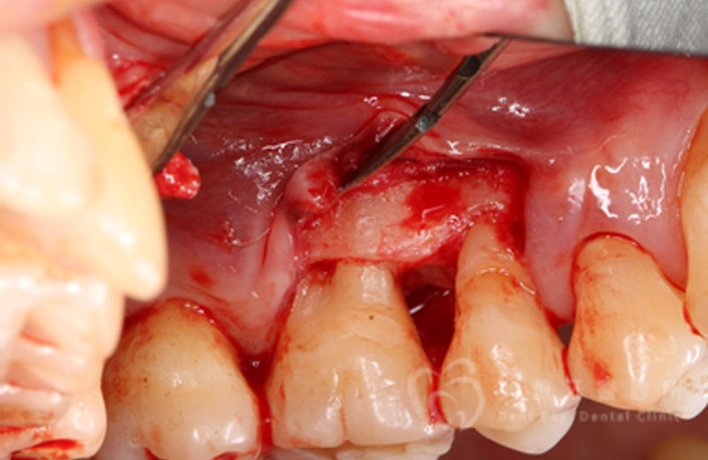牙周手術案例三