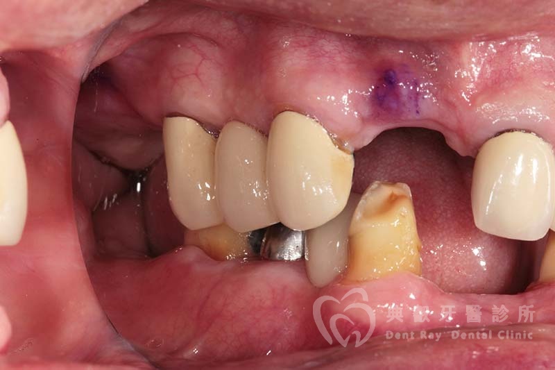 假牙案例九