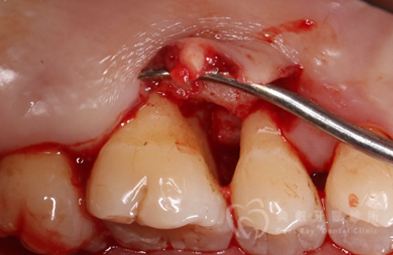 牙周手術案例三