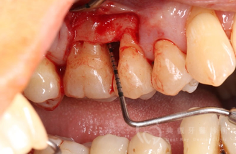 牙周手術案例三