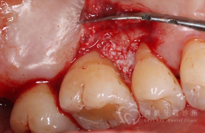 牙周手術案例三