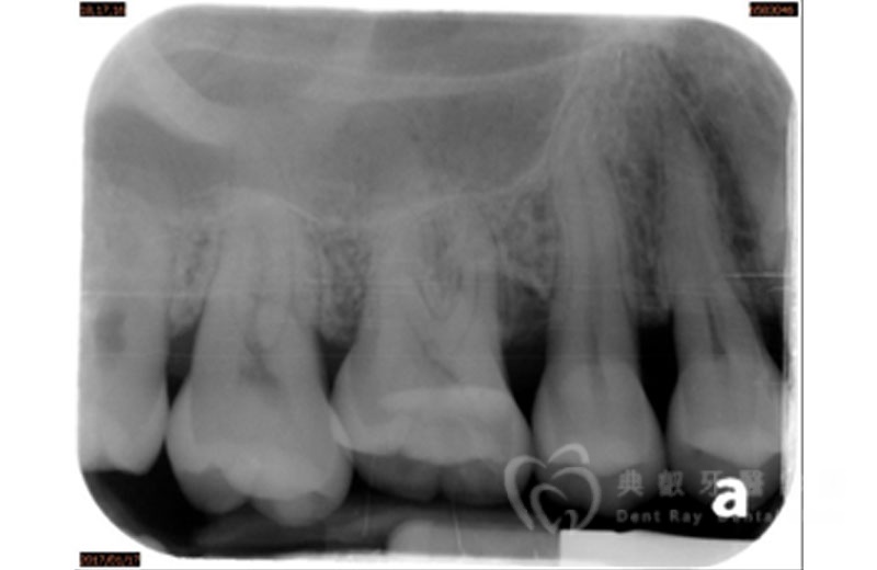 牙周手術案例三