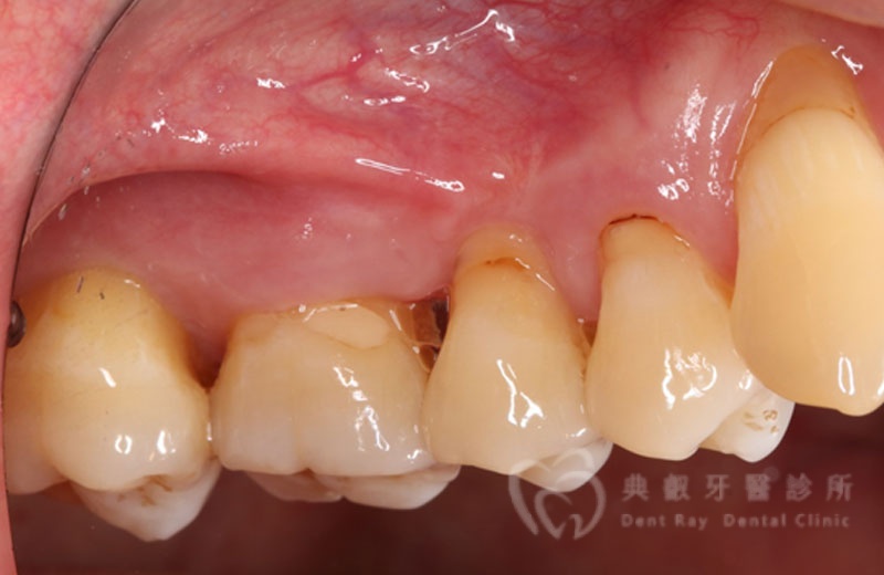 牙周手術案例三