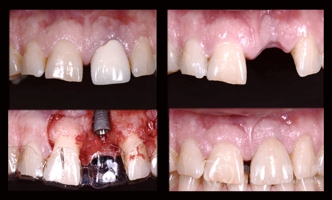 引導骨頭再生術