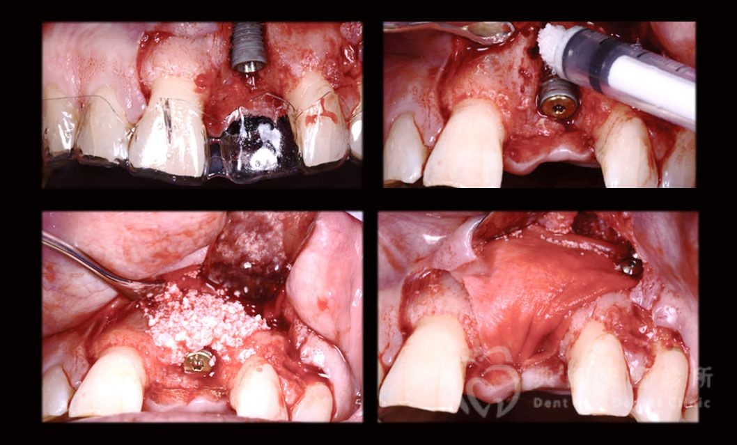 引導骨頭再生術