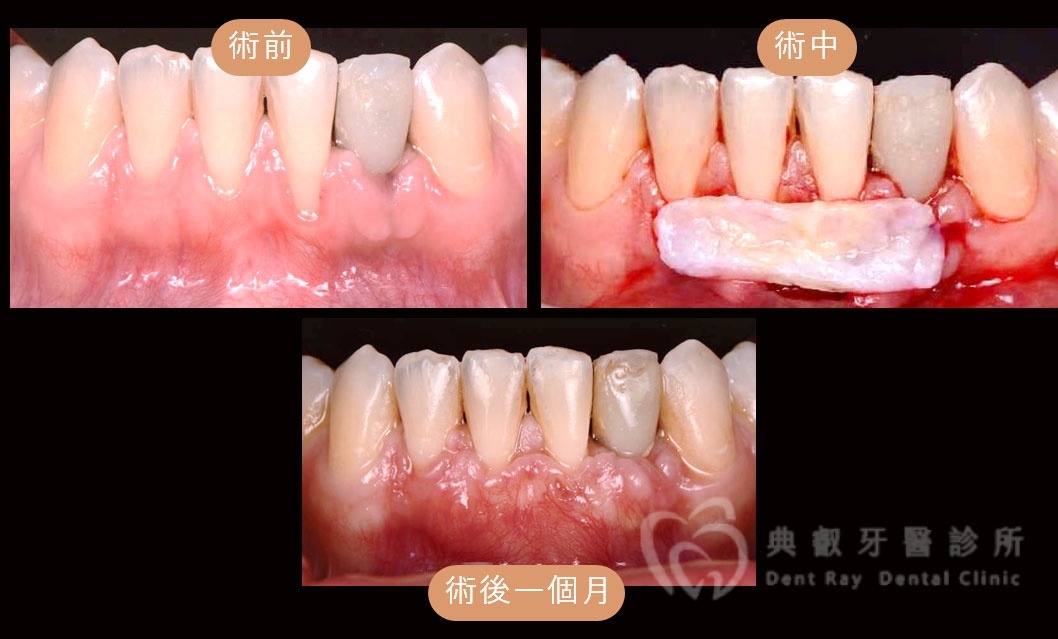 牙齦美學補肉手術