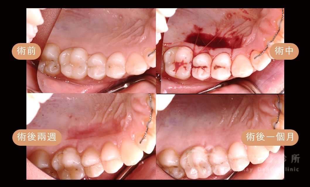 牙齦美學補肉手術