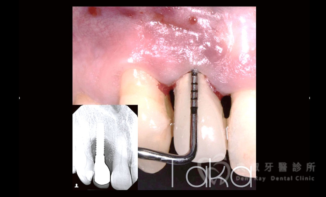 舊有植體失敗處理