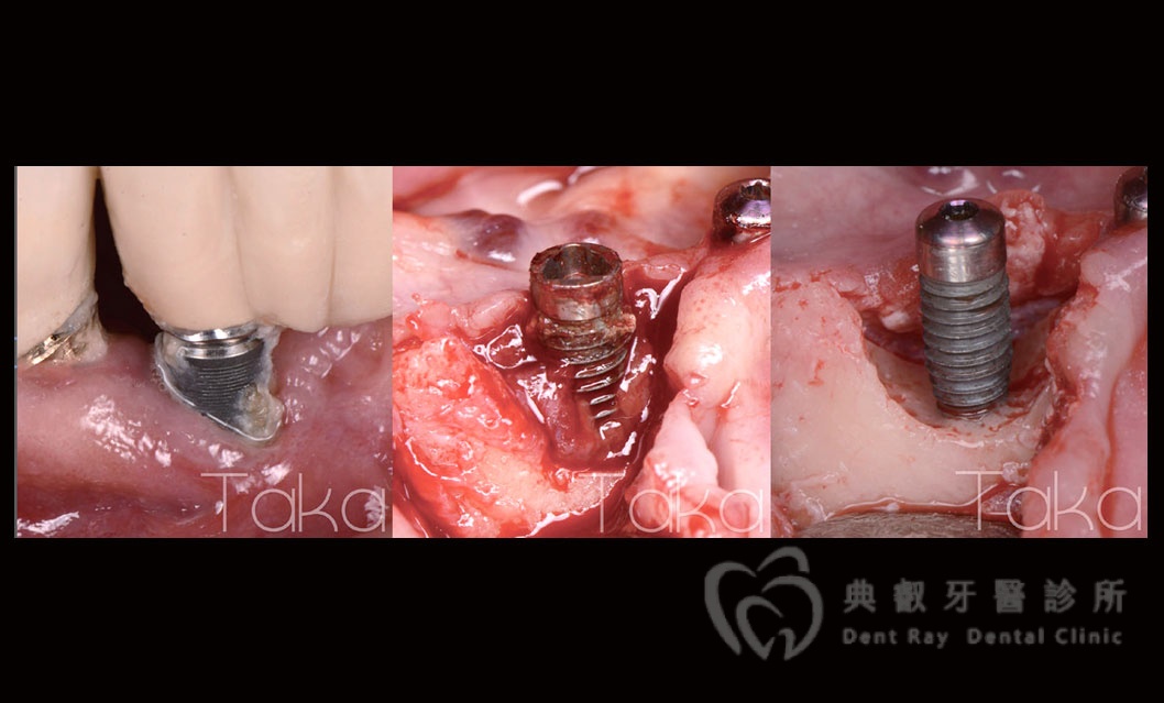 舊有植體失敗處理