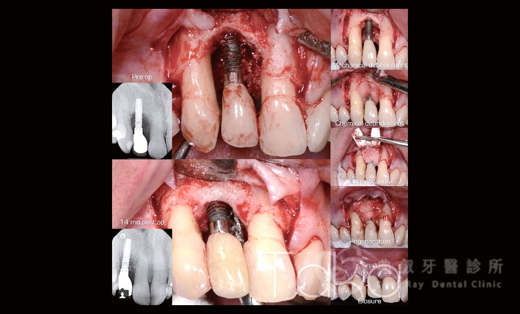 舊有植體失敗處理