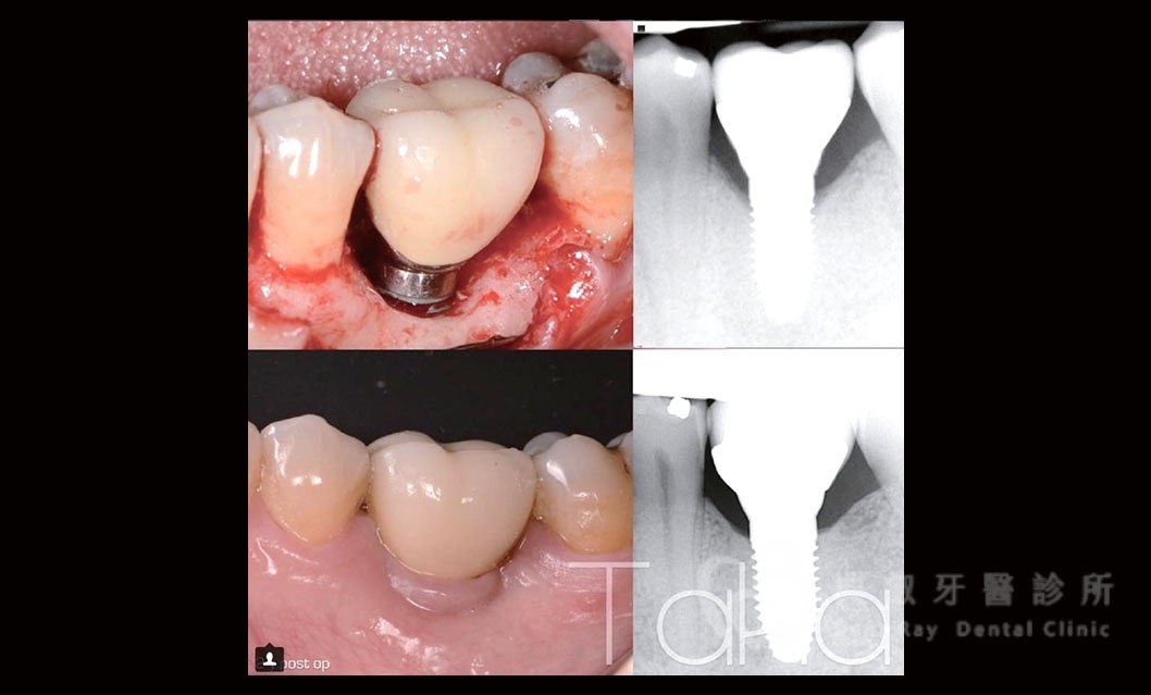 舊有植體失敗處理