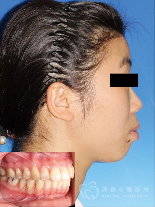 暴牙嘟嘴案例一