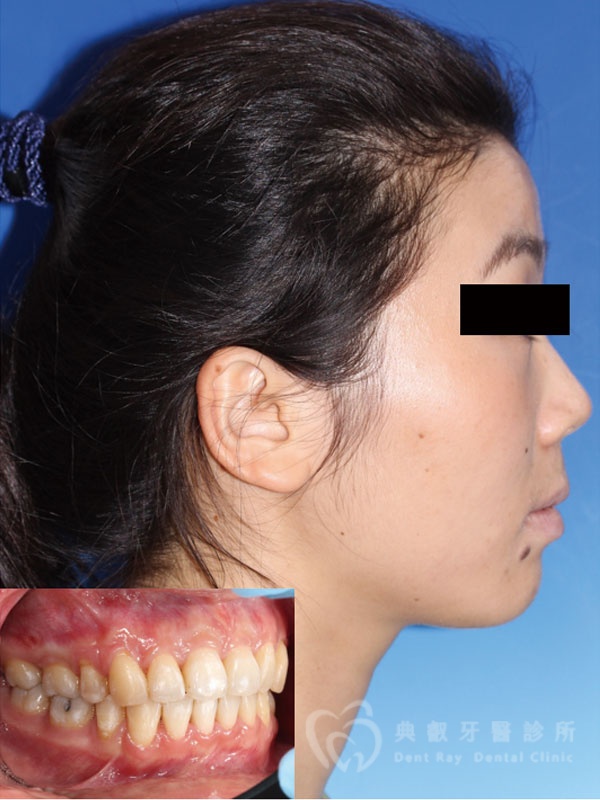 暴牙嘟嘴案例一