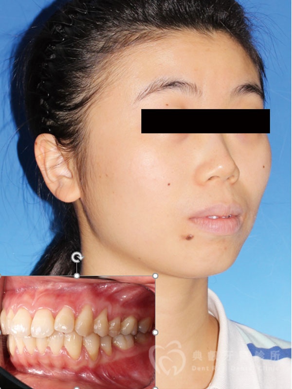 暴牙嘟嘴案例一