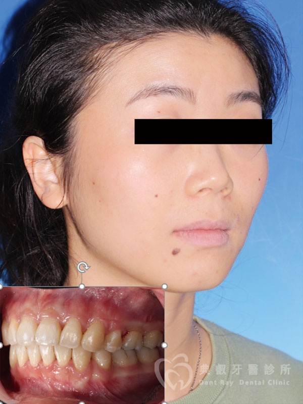 暴牙嘟嘴案例一