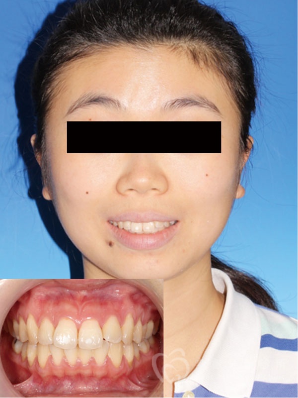 暴牙嘟嘴案例一