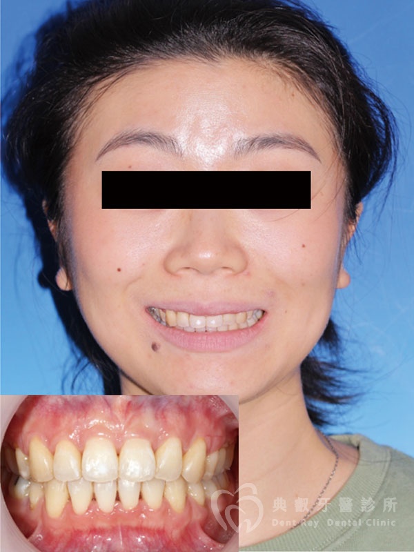 暴牙嘟嘴案例一